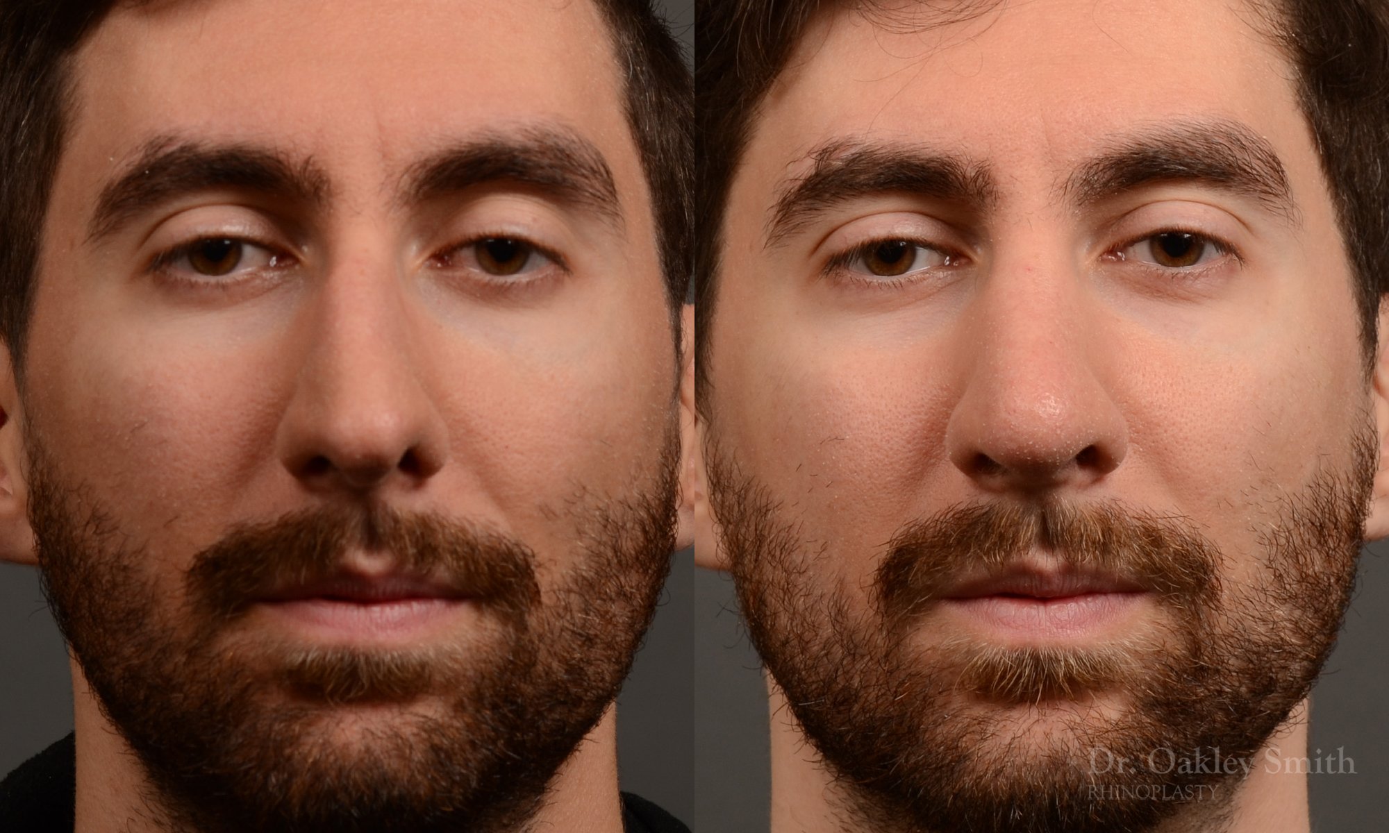 Rhinoplasty - Rhinoplasty Before and After Case 469
