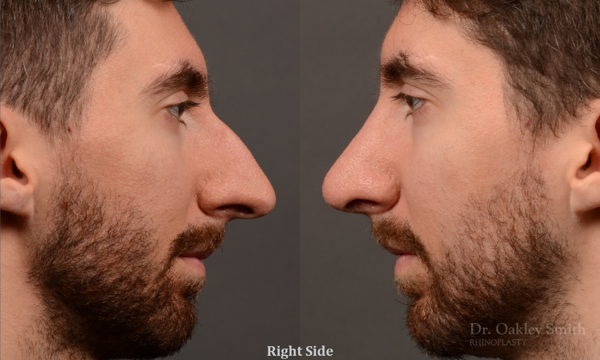Rhinoplasty - Rhinoplasty Before and After Case 469