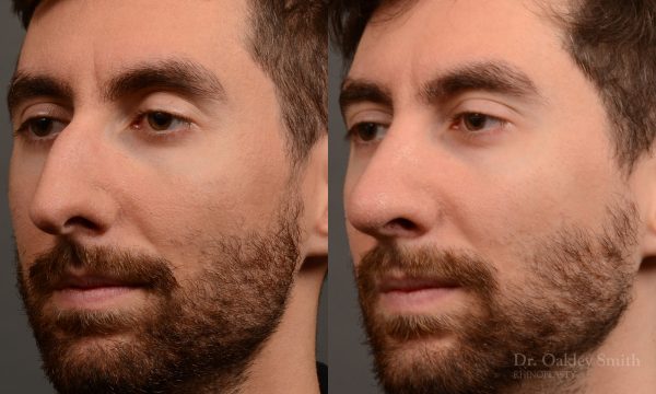 Rhinoplasty - Rhinoplasty Before and After Case 469