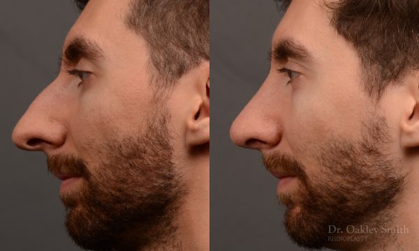 Rhinoplasty - Rhinoplasty Before and After Case 469