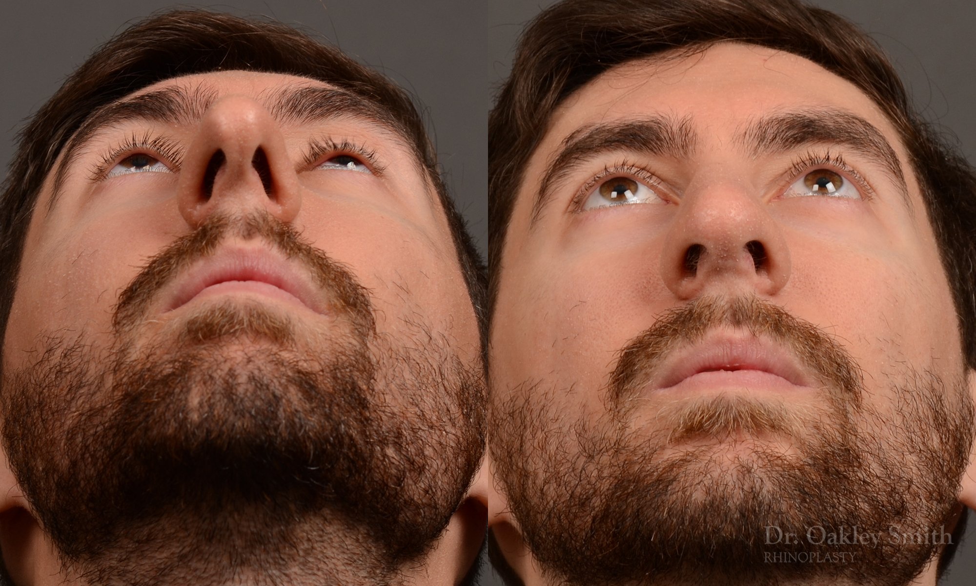 Rhinoplasty - Rhinoplasty Before and After Case 469