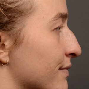 Rhinoplasty - Rhinoplasty Before and After Case 470