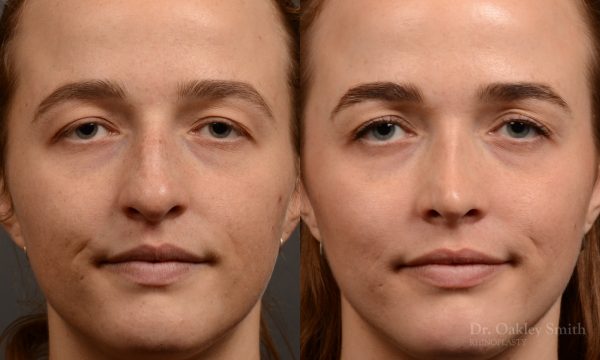 Rhinoplasty - Rhinoplasty Before and After Case 470