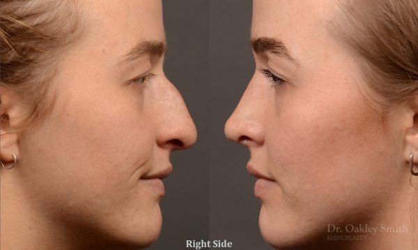 Rhinoplasty - Rhinoplasty Before and After Case 470