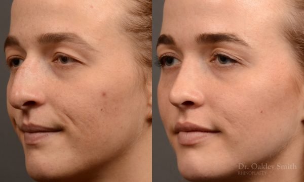 Rhinoplasty - Rhinoplasty Before and After Case 470