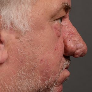 Septoplasty - Septoplasty Before and After – Case 471