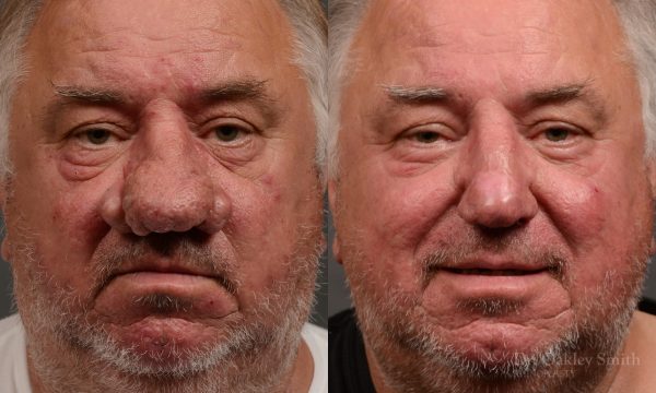 Septoplasty - Septoplasty Before and After – Case 471