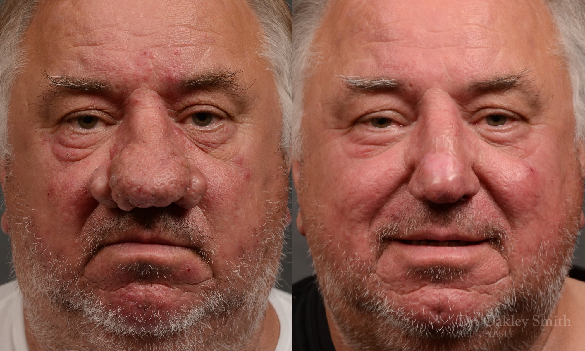 Septoplasty - Septoplasty Before and After – Case 471