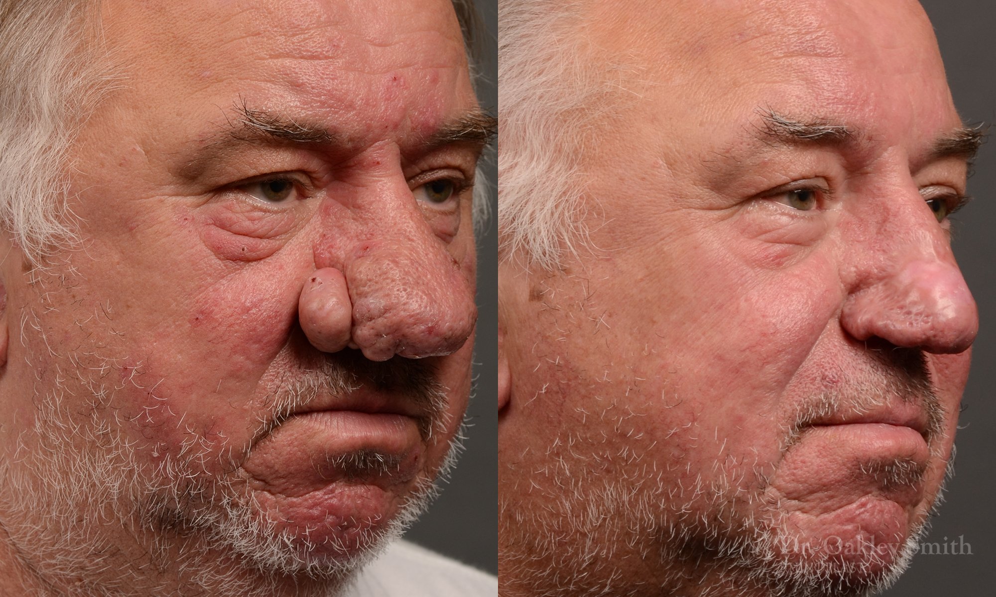Septoplasty - Septoplasty Before and After – Case 471
