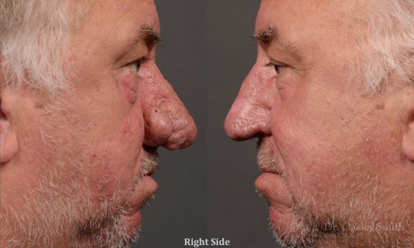 Septoplasty - Septoplasty Before and After – Case 471