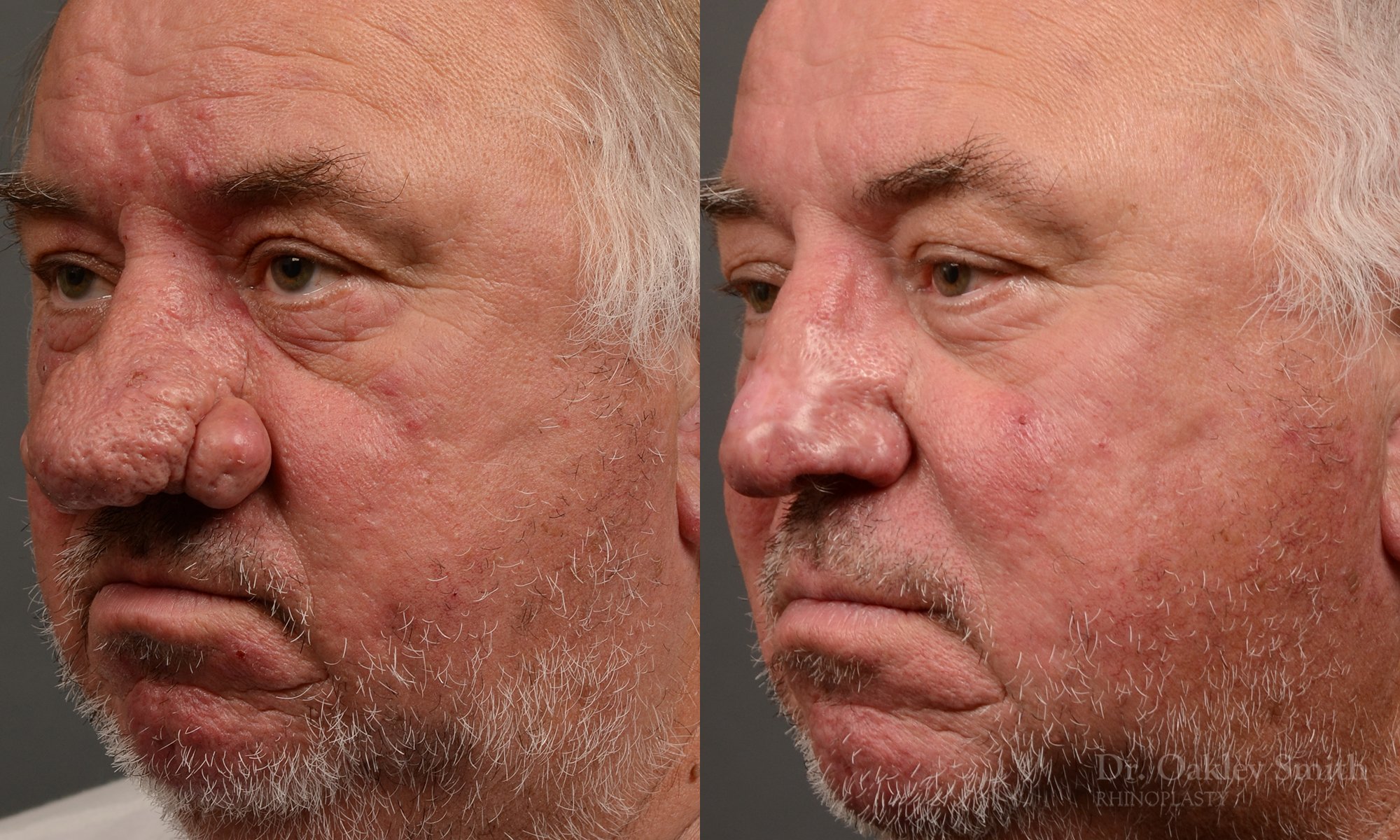 Septoplasty - Septoplasty Before and After – Case 471