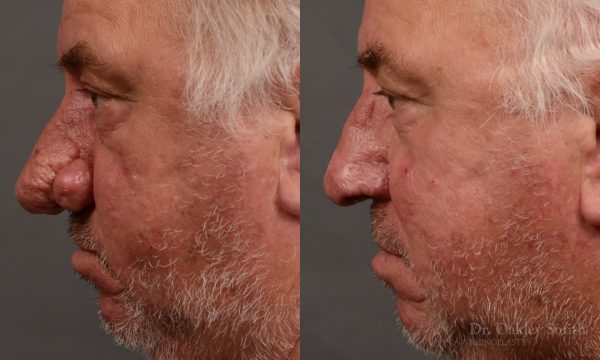 Septoplasty - Septoplasty Before and After – Case 471