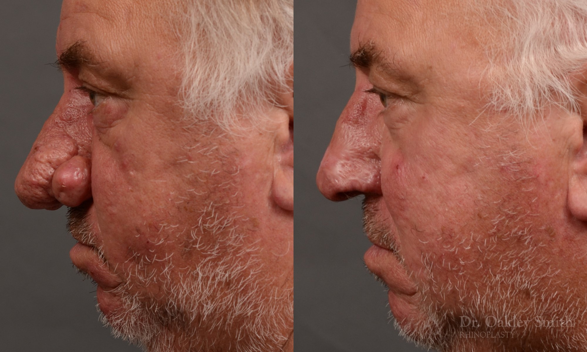 Septoplasty - Septoplasty Before and After – Case 471