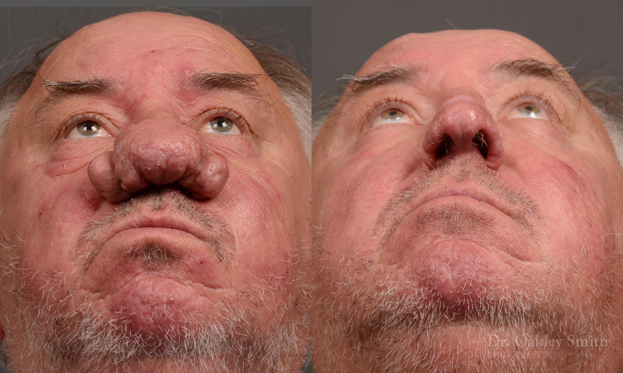 Septoplasty - Septoplasty Before and After – Case 471