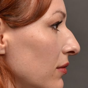 Rhinoplasty - Rhinoplasty Before After Case 472