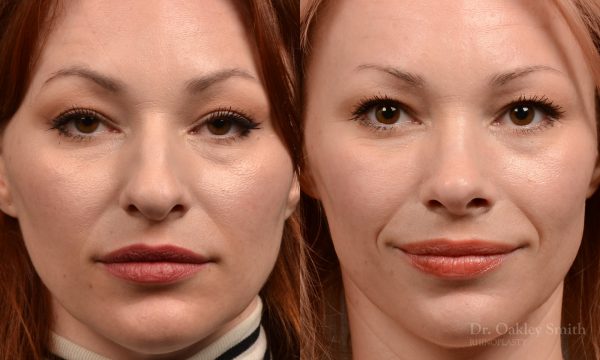 Rhinoplasty - Rhinoplasty Before After Case 472