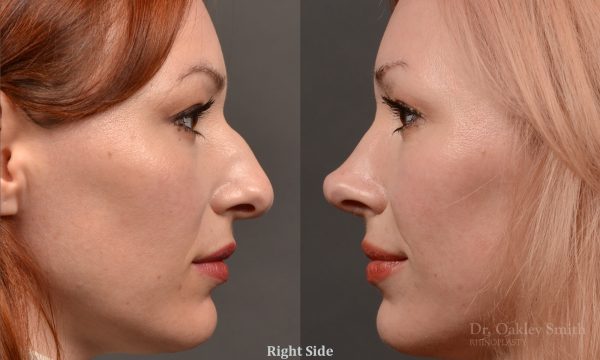 Rhinoplasty - Rhinoplasty Before After Case 472