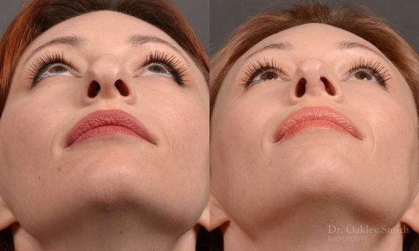 Rhinoplasty - Rhinoplasty Before After Case 472