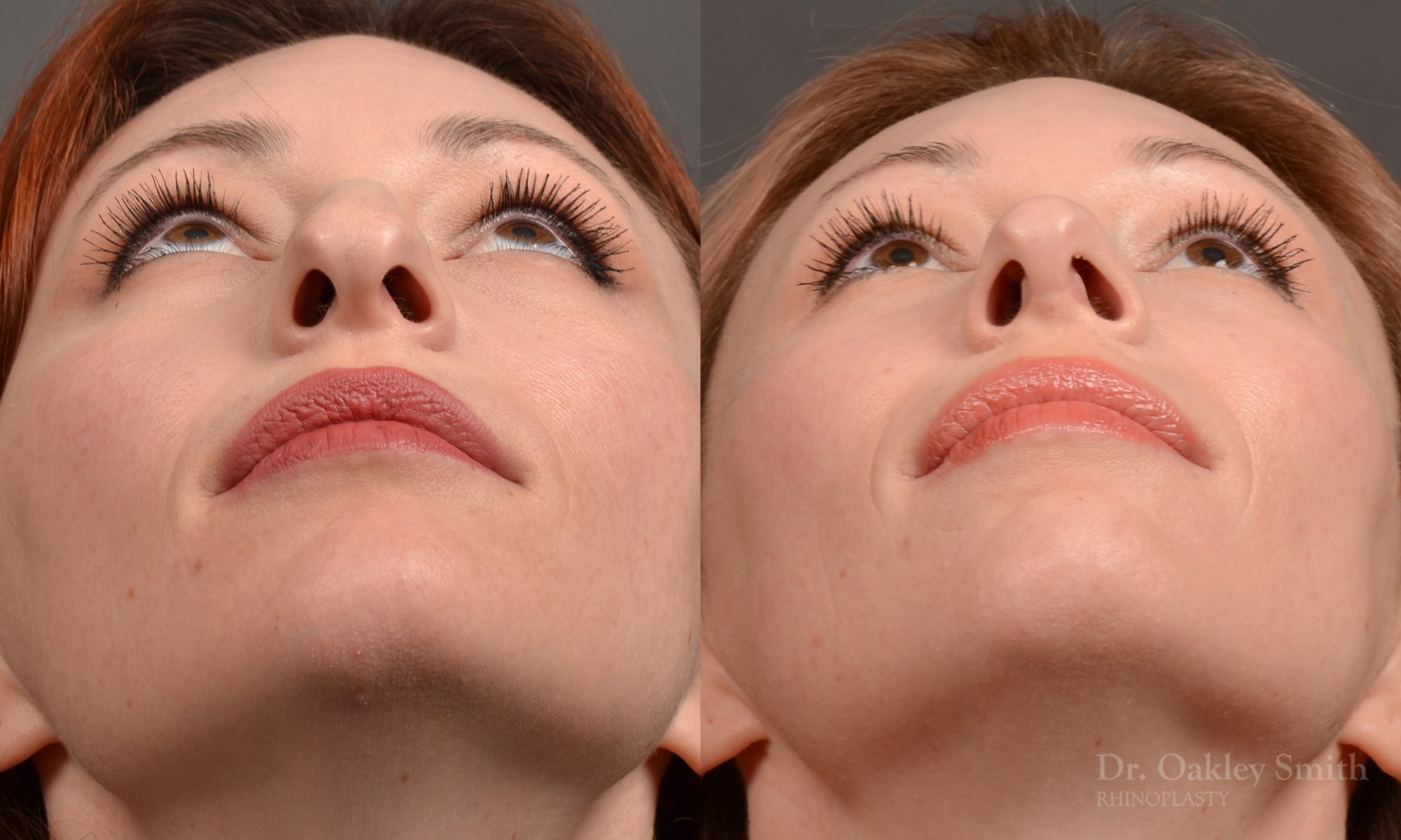 Rhinoplasty - Rhinoplasty Before After Case 472