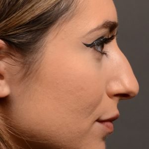 Rhinoplasty - Rhinoplasty Before After – Case 473