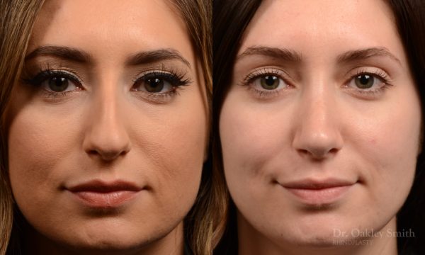 Rhinoplasty - Rhinoplasty Before After – Case 473