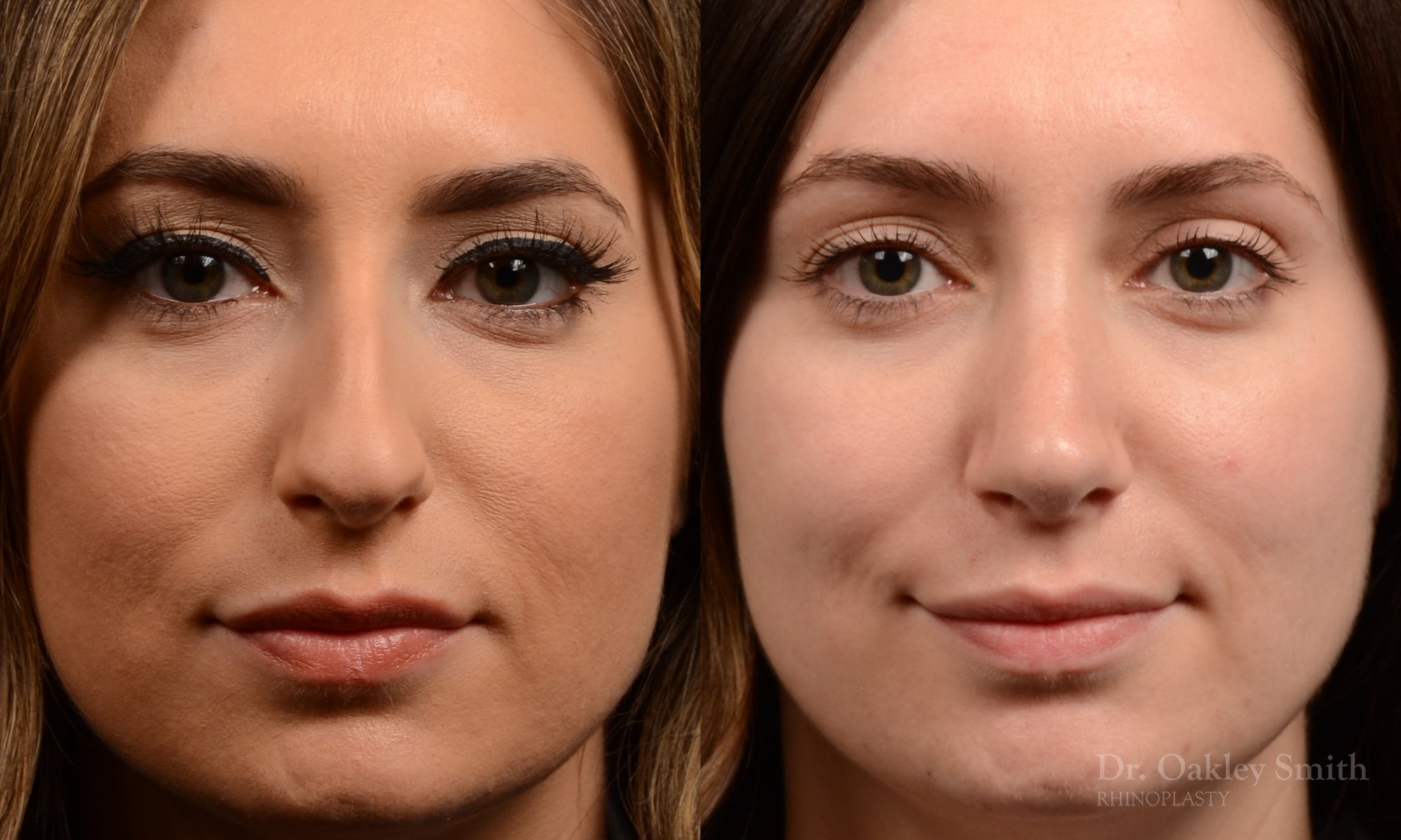 Rhinoplasty - Rhinoplasty Before After – Case 473