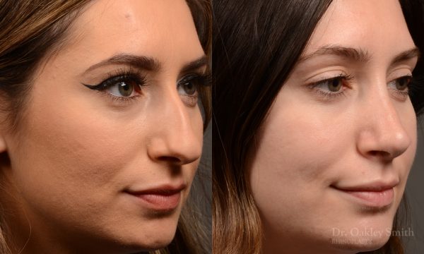 Rhinoplasty - Rhinoplasty Before After – Case 473