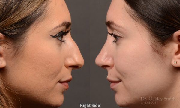 Rhinoplasty - Rhinoplasty Before After – Case 473
