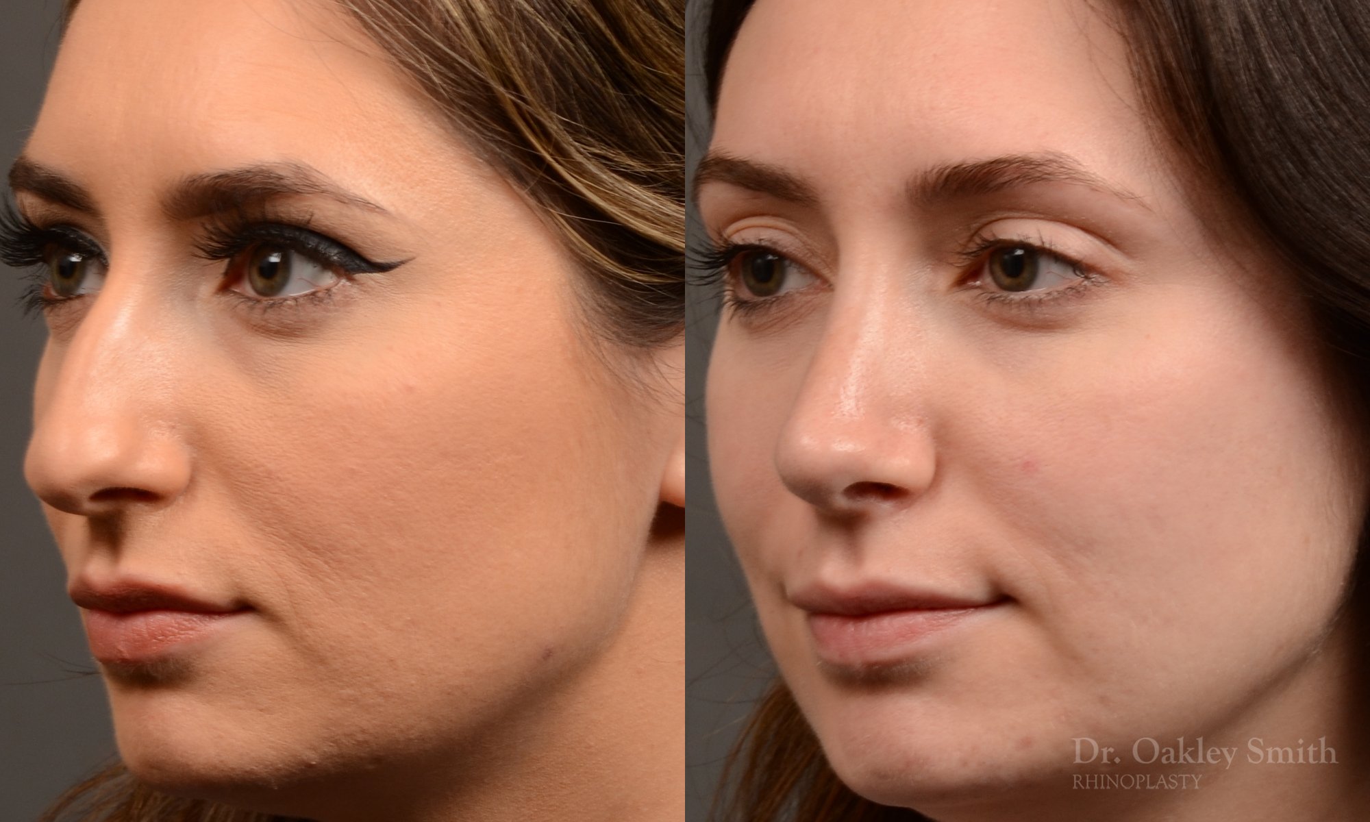 Rhinoplasty - Rhinoplasty Before After – Case 473