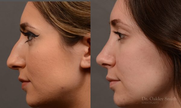 Rhinoplasty - Rhinoplasty Before After – Case 473