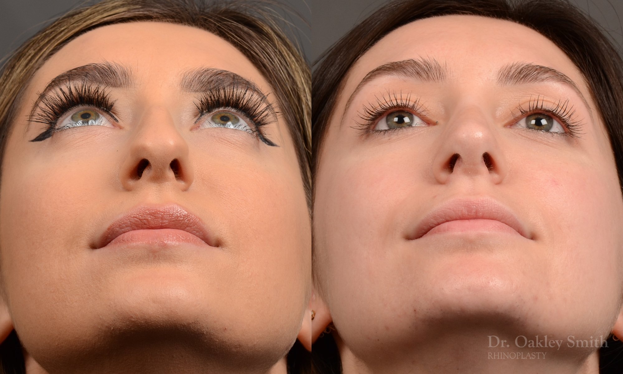 Rhinoplasty - Rhinoplasty Before After – Case 473