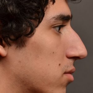 Rhinoplasty, Septoplasty - Rhinoplasty Before After Case 474
