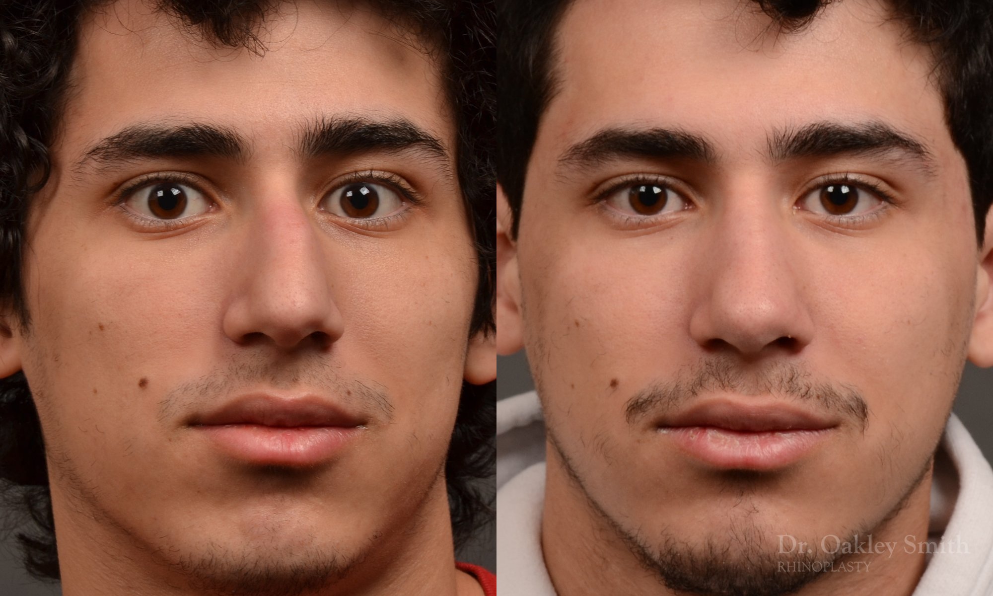Rhinoplasty, Septoplasty - Rhinoplasty Before After Case 474