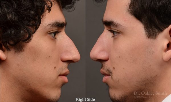 Rhinoplasty, Septoplasty - Rhinoplasty Before After Case 474