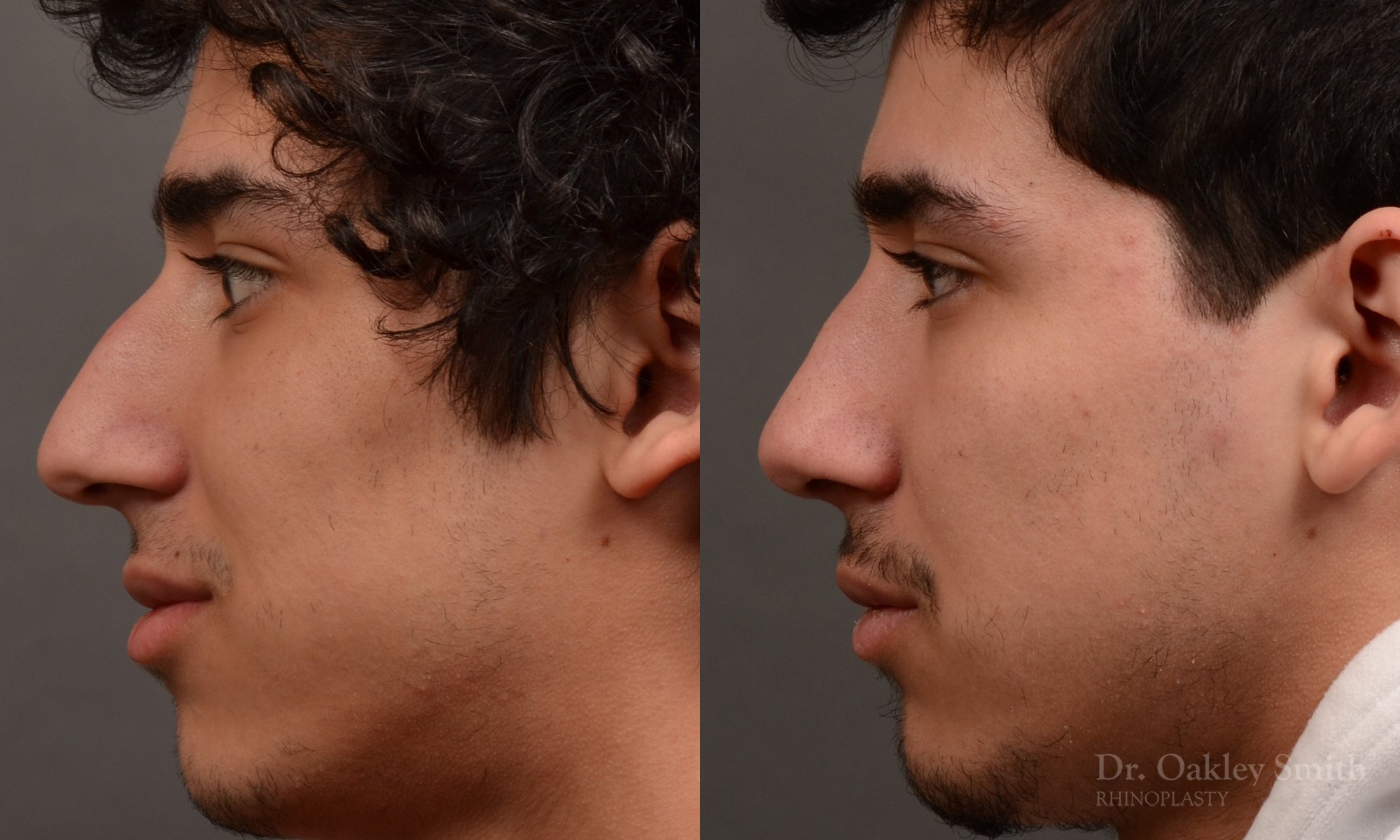 Rhinoplasty, Septoplasty - Rhinoplasty Before After Case 474