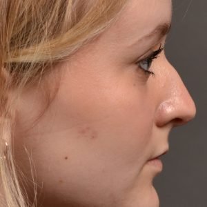Rhinoplasty - Rhinoplasty Before and After – Case 475