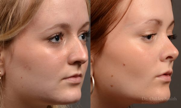 Rhinoplasty - Rhinoplasty Before and After – Case 475
