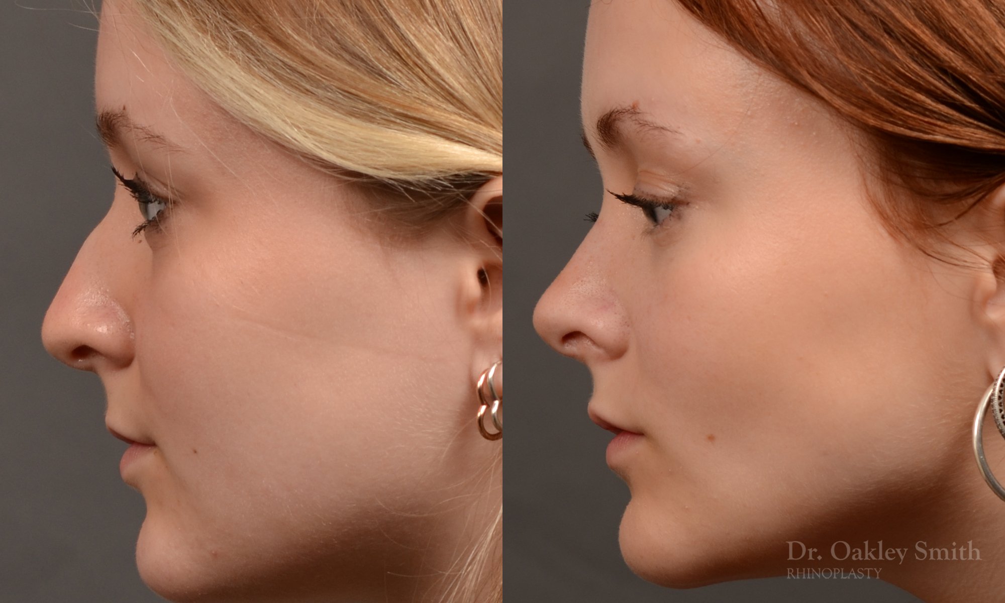 Rhinoplasty - Rhinoplasty Before and After – Case 475