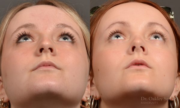 Rhinoplasty - Rhinoplasty Before and After – Case 475