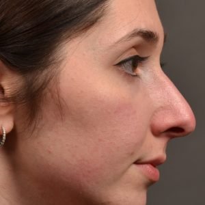 Rhinoplasty - Rhinoplasty Before and After Case 476