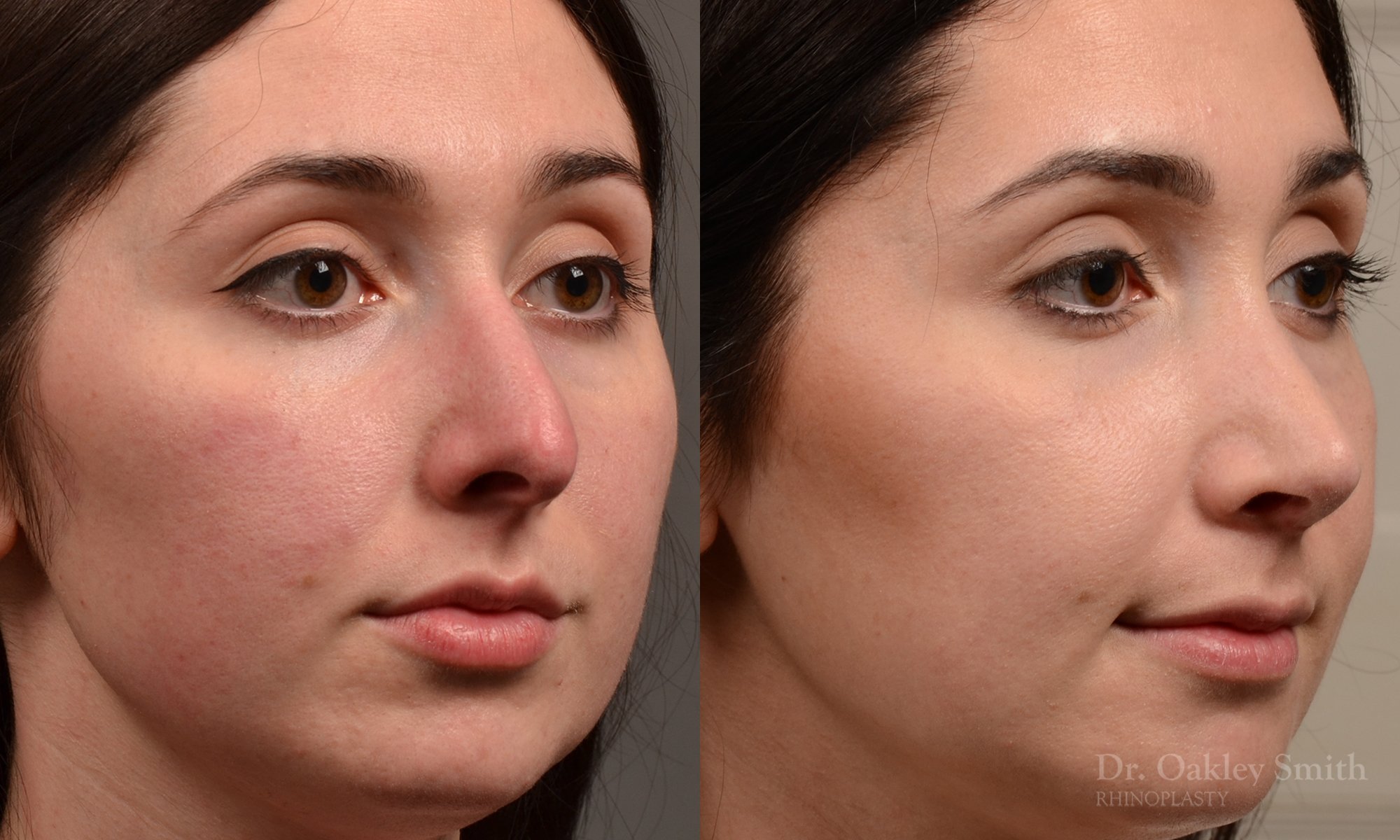 Rhinoplasty - Rhinoplasty Before and After Case 476