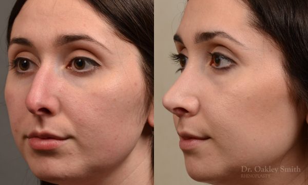 Rhinoplasty - Rhinoplasty Before and After Case 476