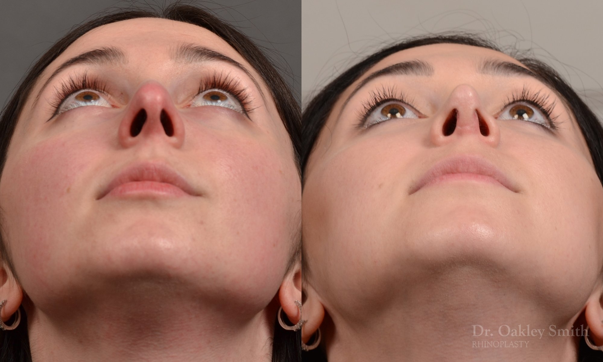 Rhinoplasty - Rhinoplasty Before and After Case 476