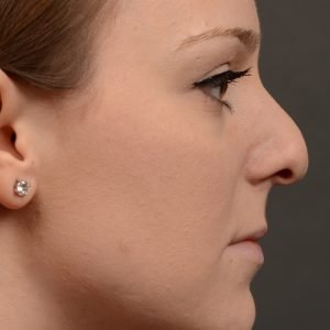 Rhinoplasty, Septoplasty - Rhinoplasty Before and After Case 476
