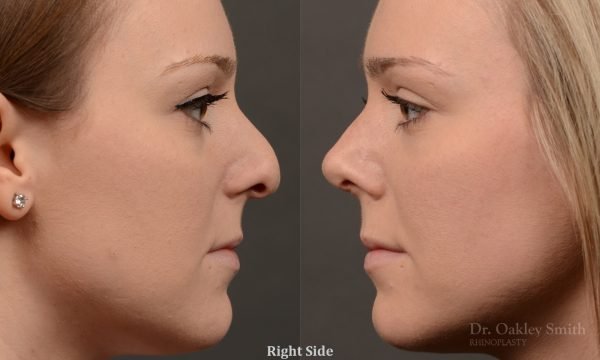 Rhinoplasty, Septoplasty - Rhinoplasty Before and After Case 476