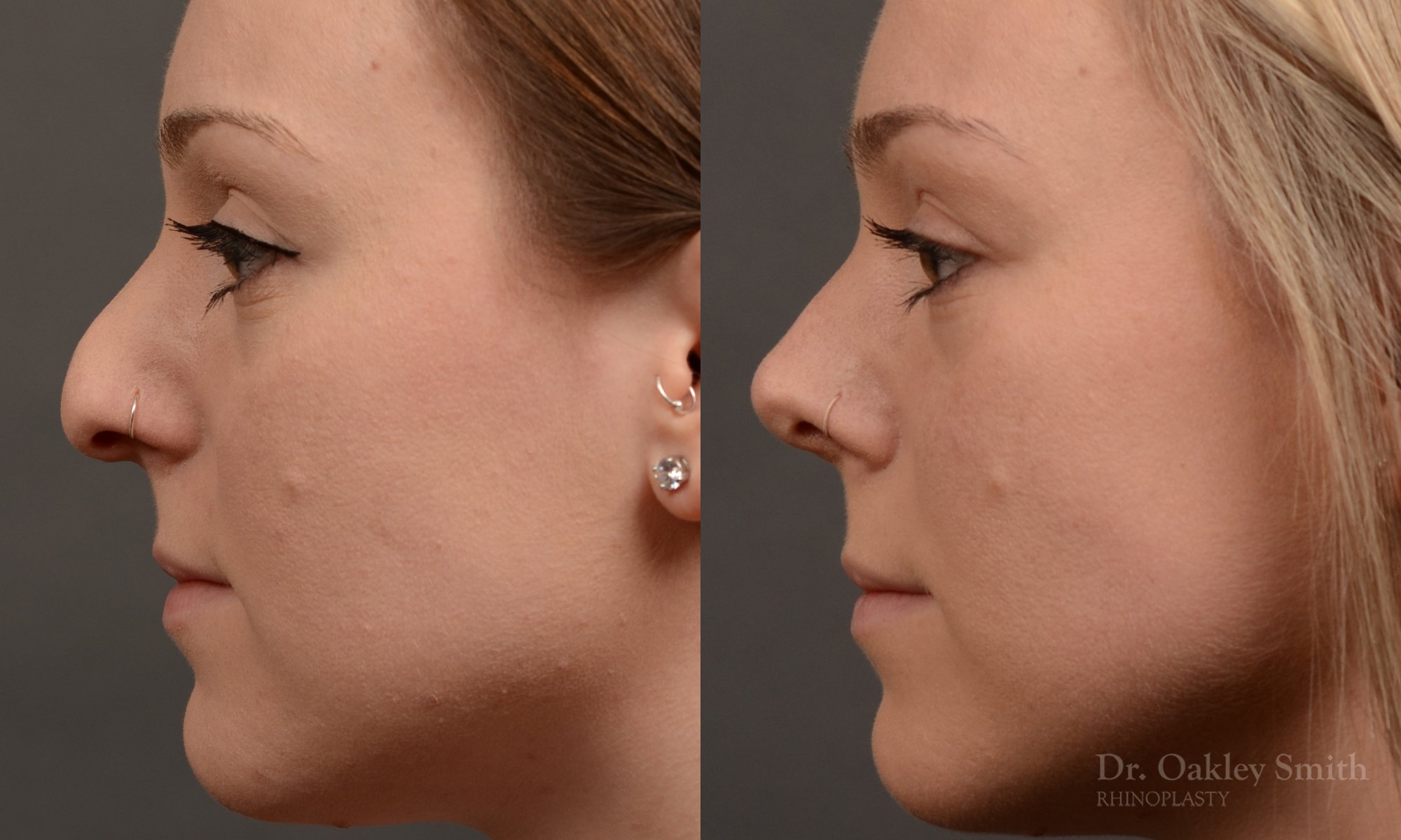 Rhinoplasty, Septoplasty - Rhinoplasty Before and After Case 476