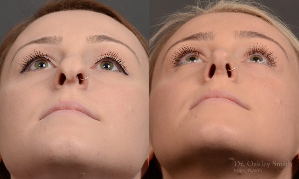 Rhinoplasty, Septoplasty - Rhinoplasty Before and After Case 476