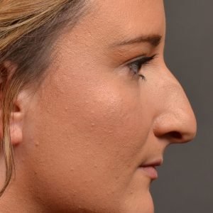 Rhinoplasty, Septoplasty - Rhinoplasty Before and After Case 478