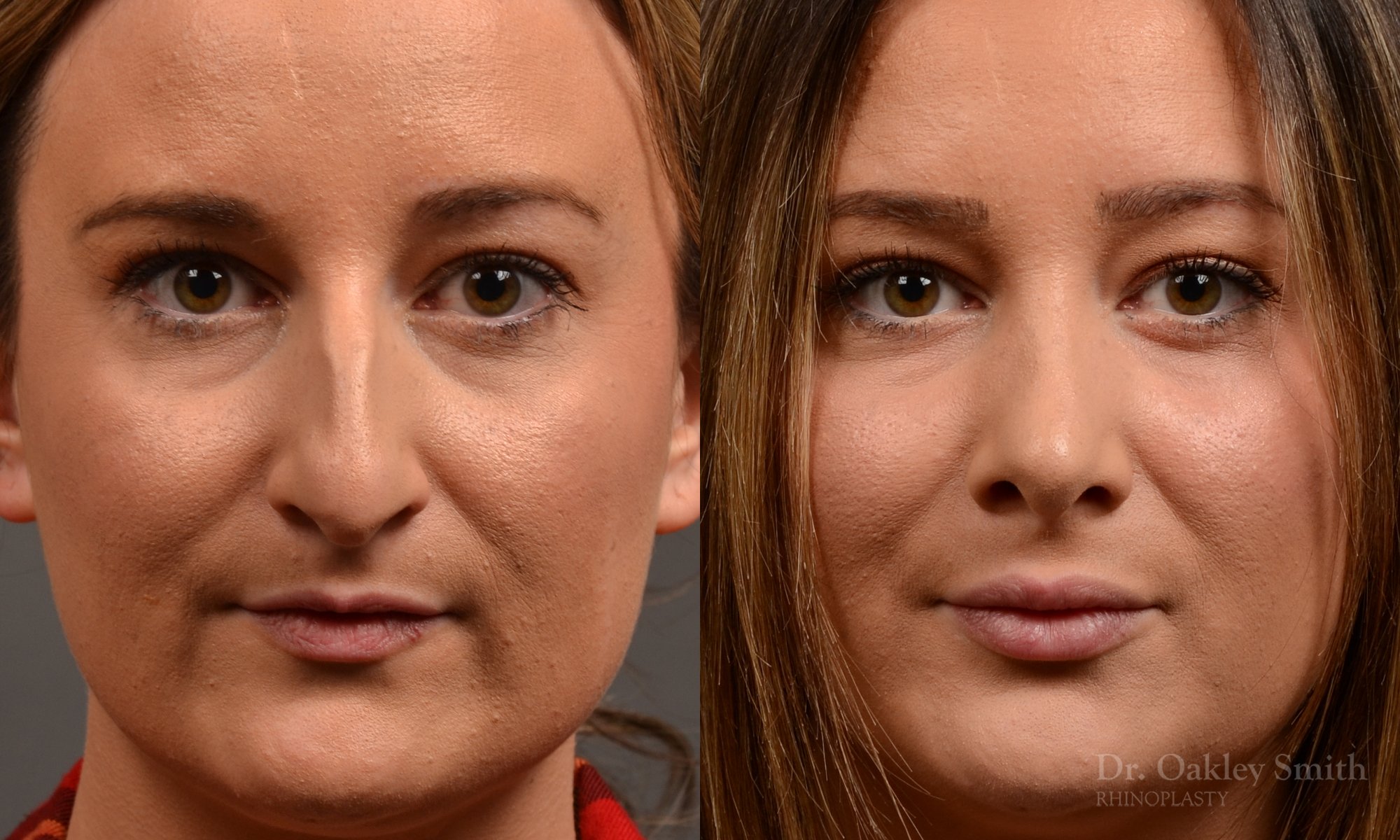 Rhinoplasty, Septoplasty - Rhinoplasty Before and After Case 478