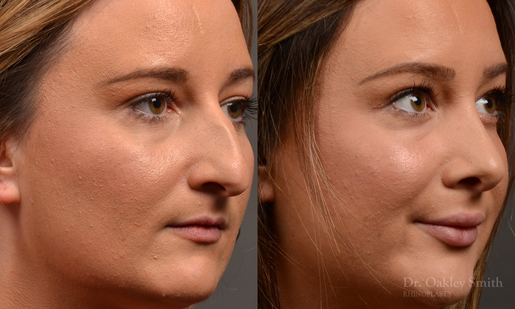 Rhinoplasty, Septoplasty - Rhinoplasty Before and After Case 478